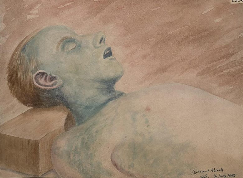 Victorian watercolor drawing of the face and chest of a man to show the appearance caused by rapid post-mortem decomposition.
