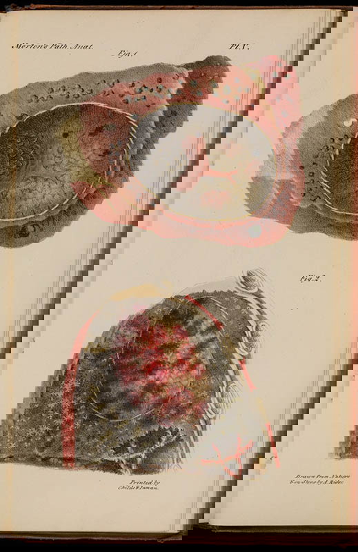 Lungs of a young man who died of Tuberculosis, Plate V, 1834, via Wellcome Collection