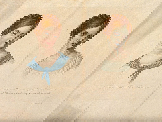 A young 23 year old Viennese who died of cholera, depicted when healthy and four hours before her death, ca. 1831, via Wellcome Collection
