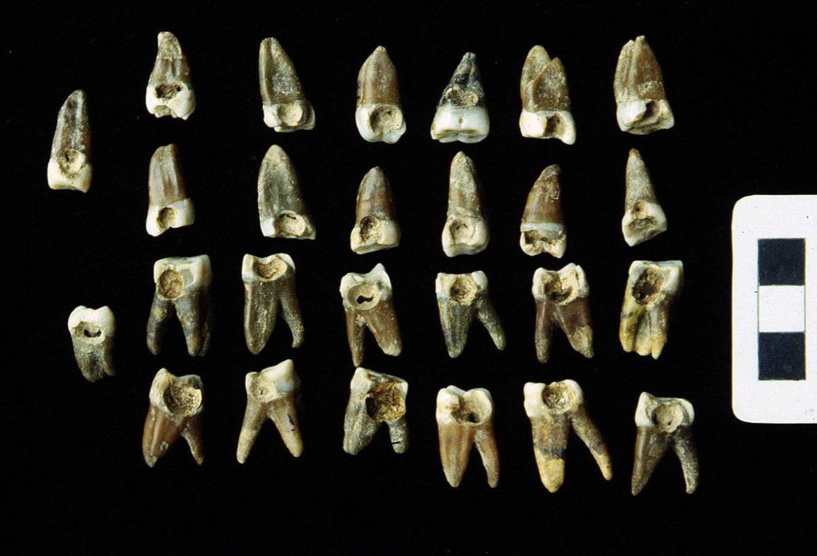 cavity filled teeth