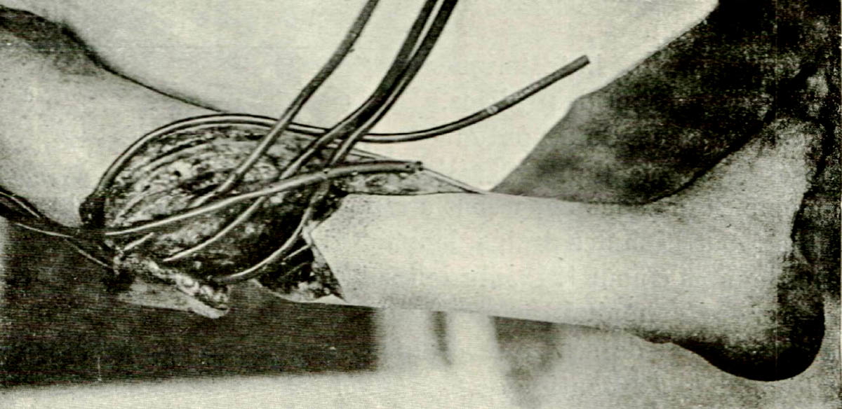 carrel dakin method tubes leg