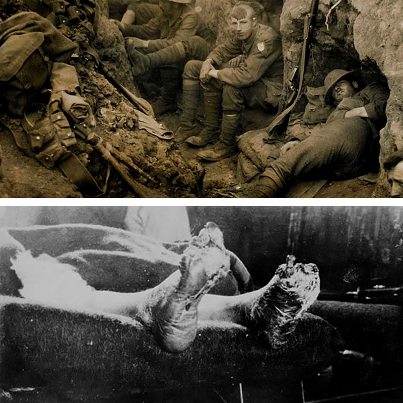 life trench foot ww1