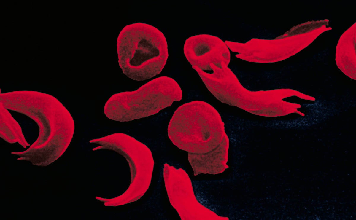 red blood cells sickle cell anemia