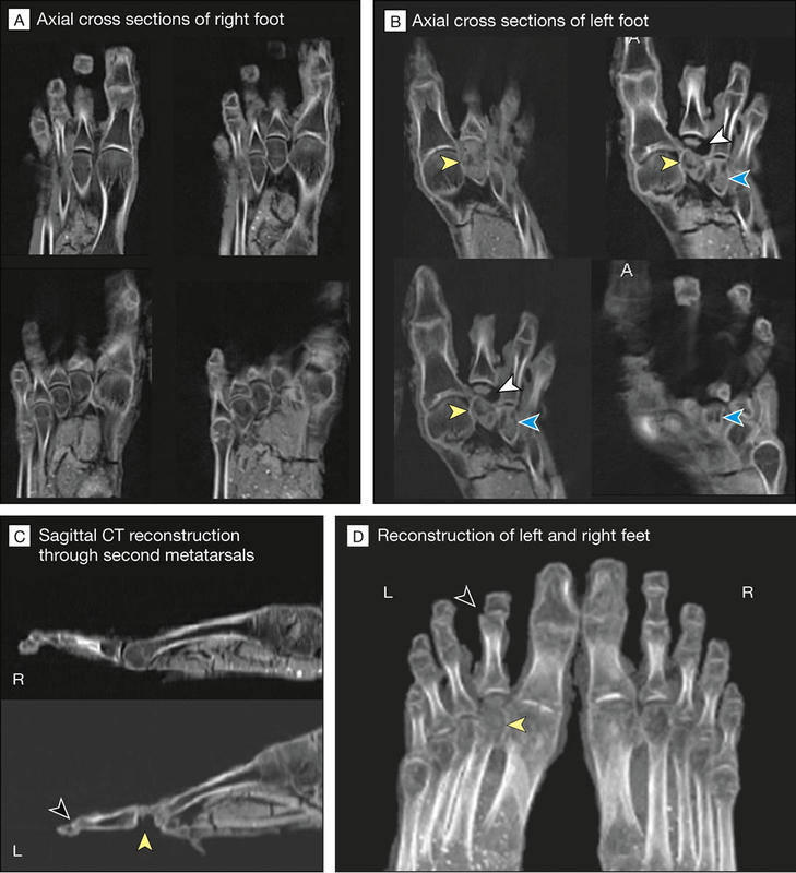 right left feet tutankhamun cat scan