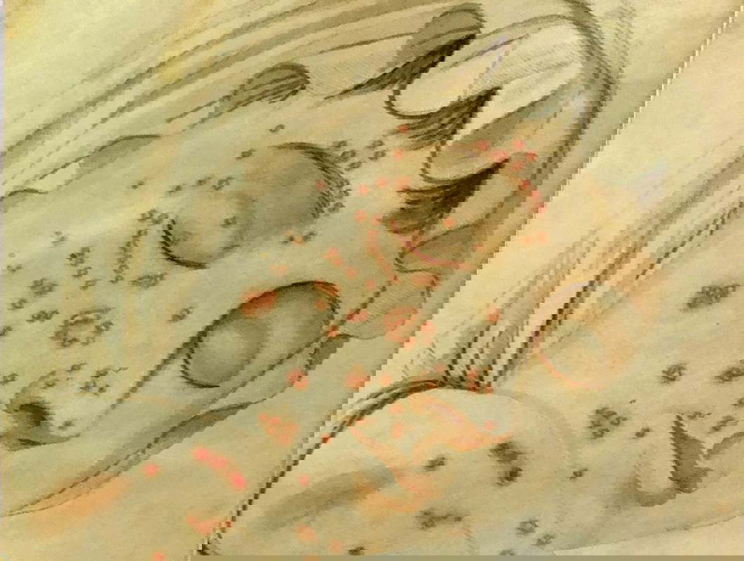 Small pox illustration