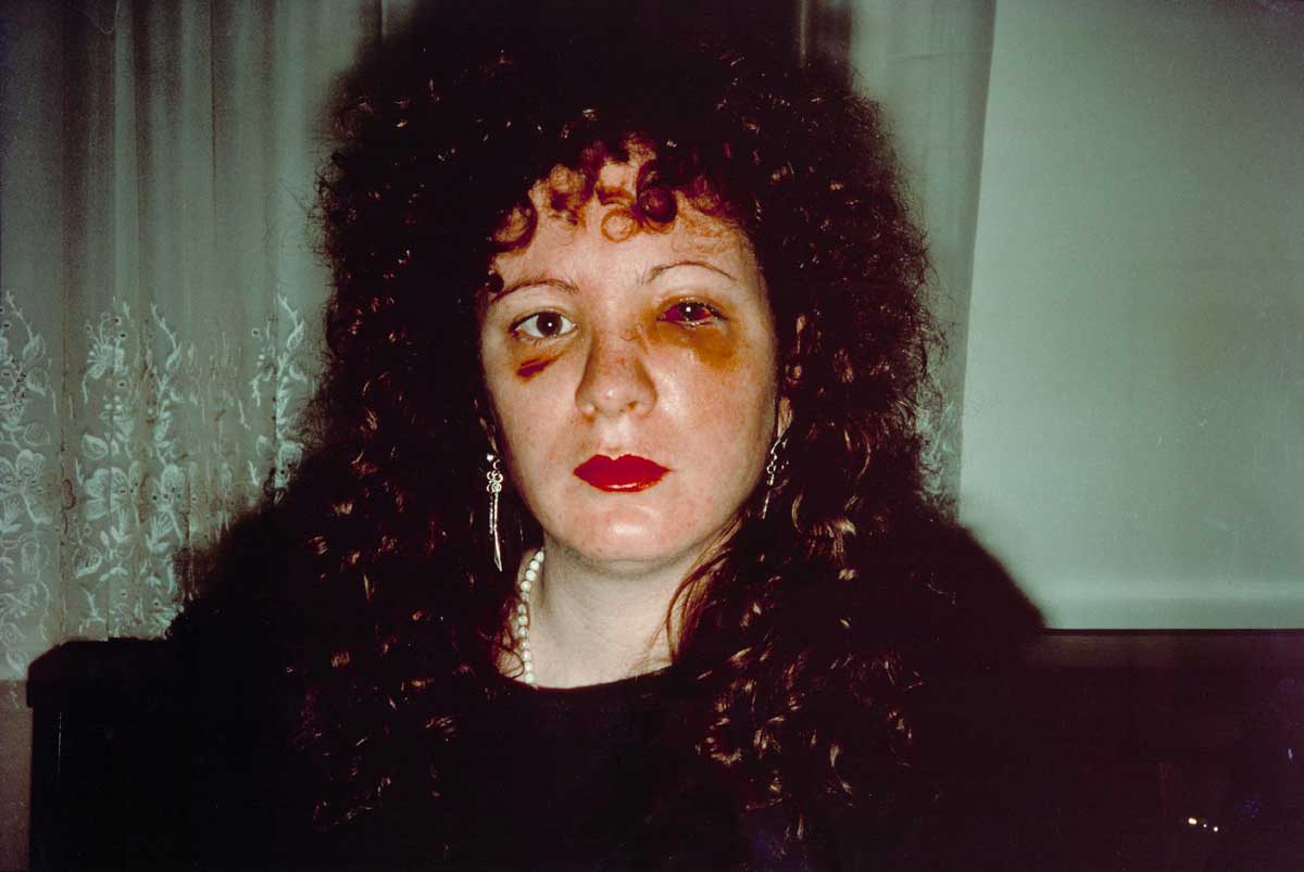 nan goldin after being battered