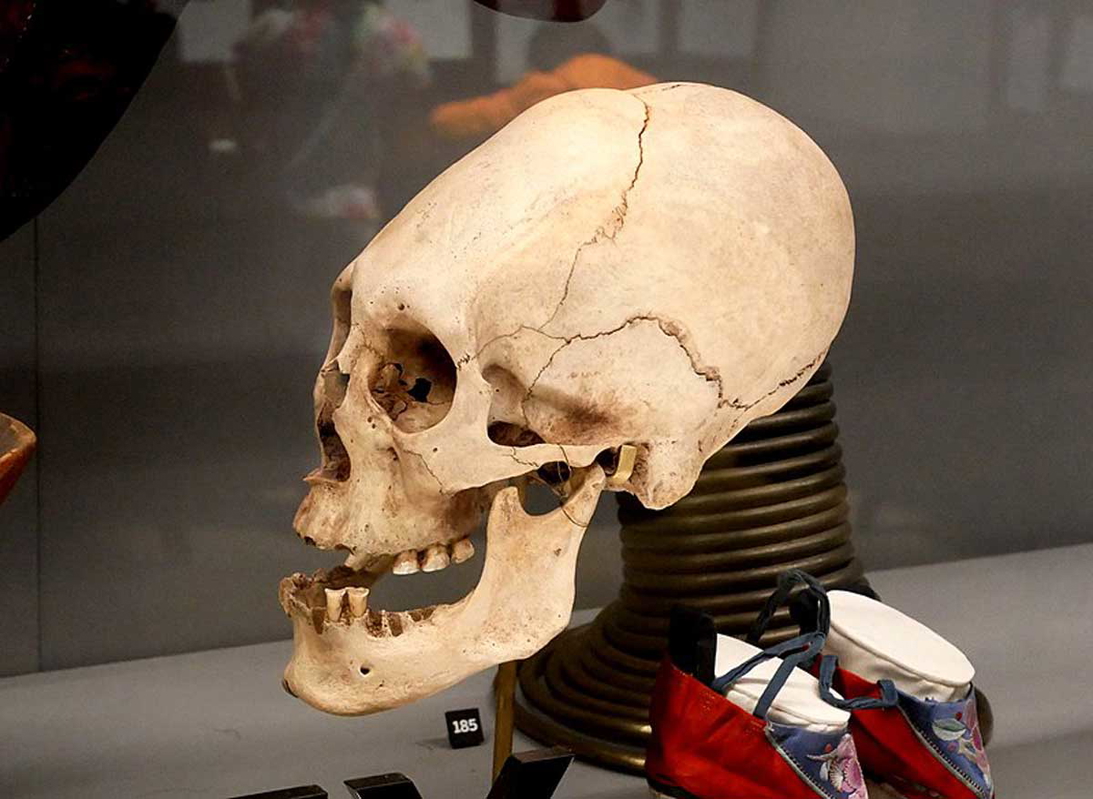 tiwanaku Deformed Skull in the Horniman Museum