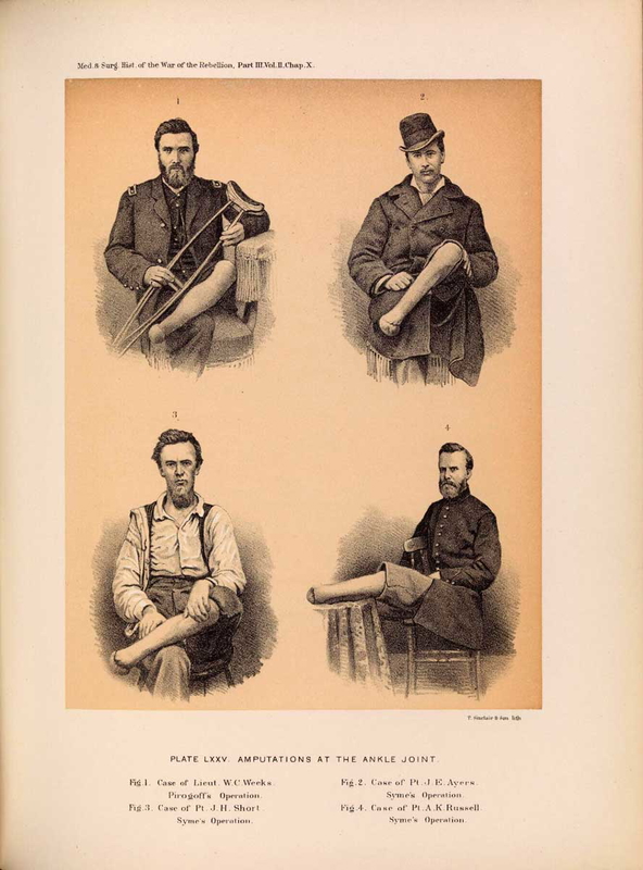 us-civil-war-gangrene-ankle-amputatons