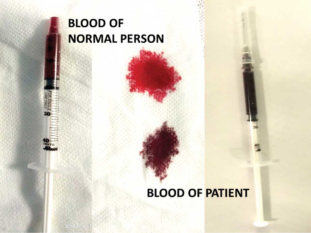 chocolate colored blood
