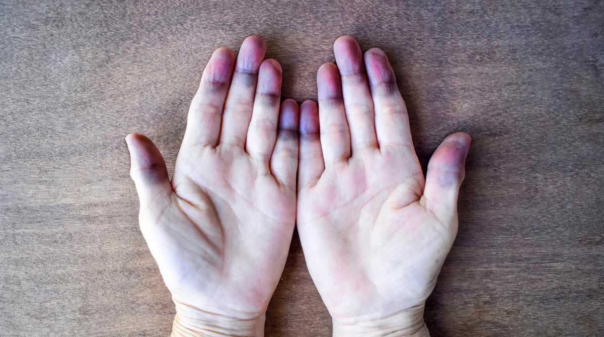 reynauds syndrome hands