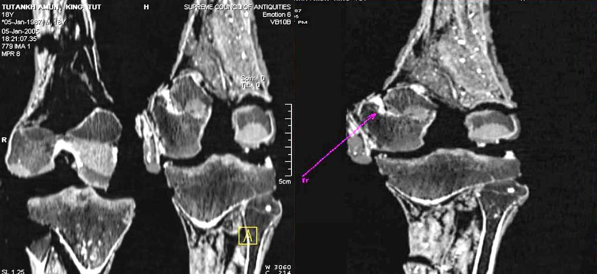 tut fracture