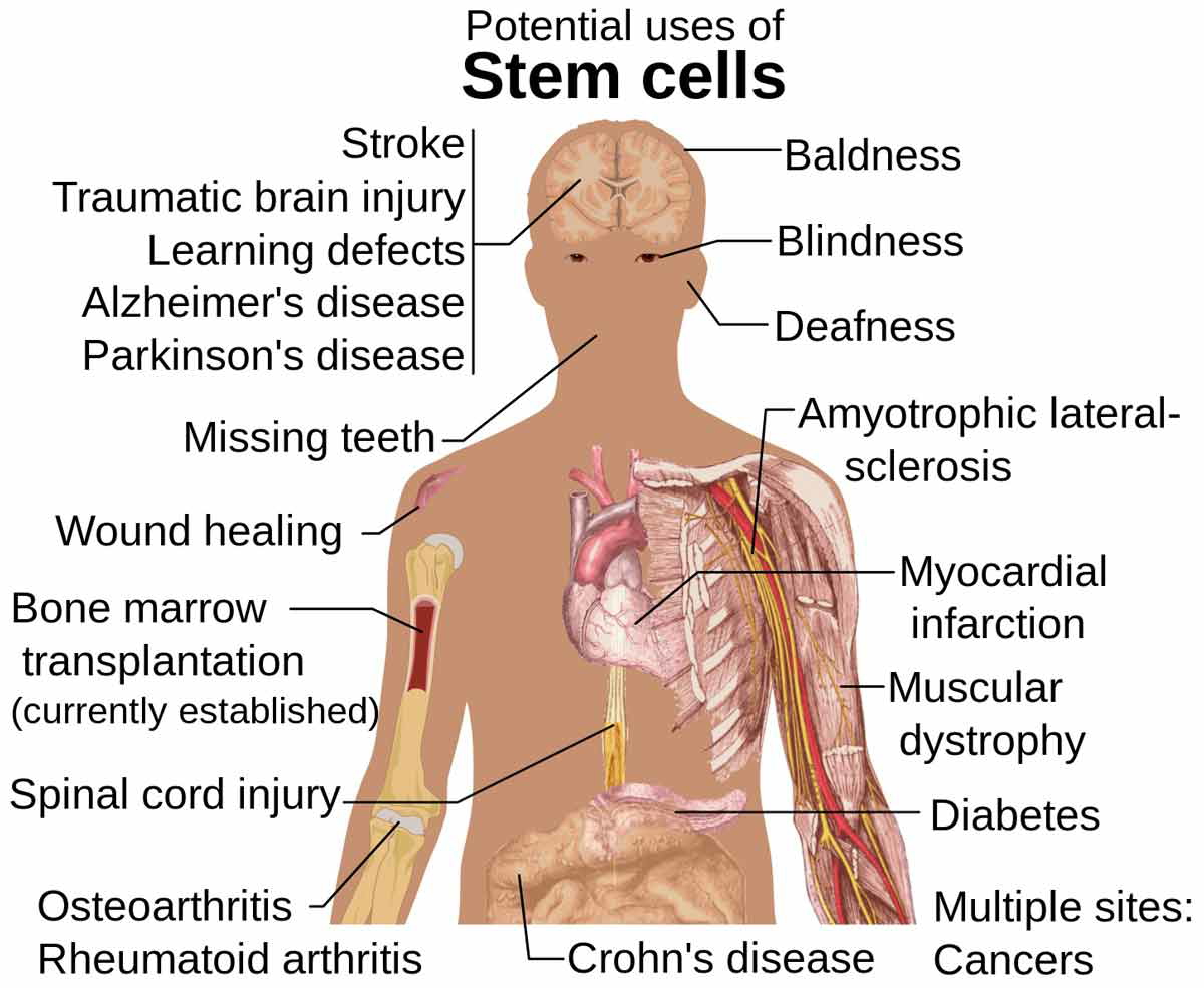 stem cells potential hiv treatment