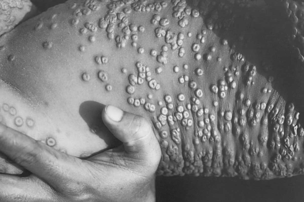 diseases changed history smallpox pustules