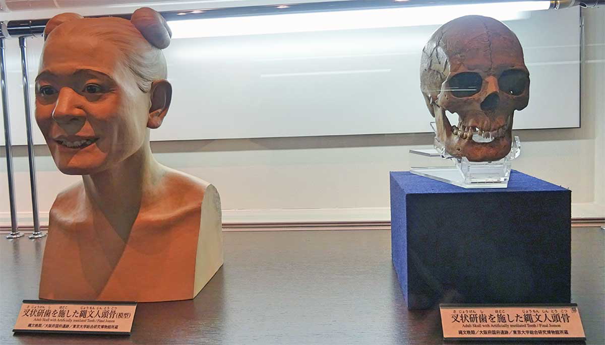 jomon skull tooth ablation
