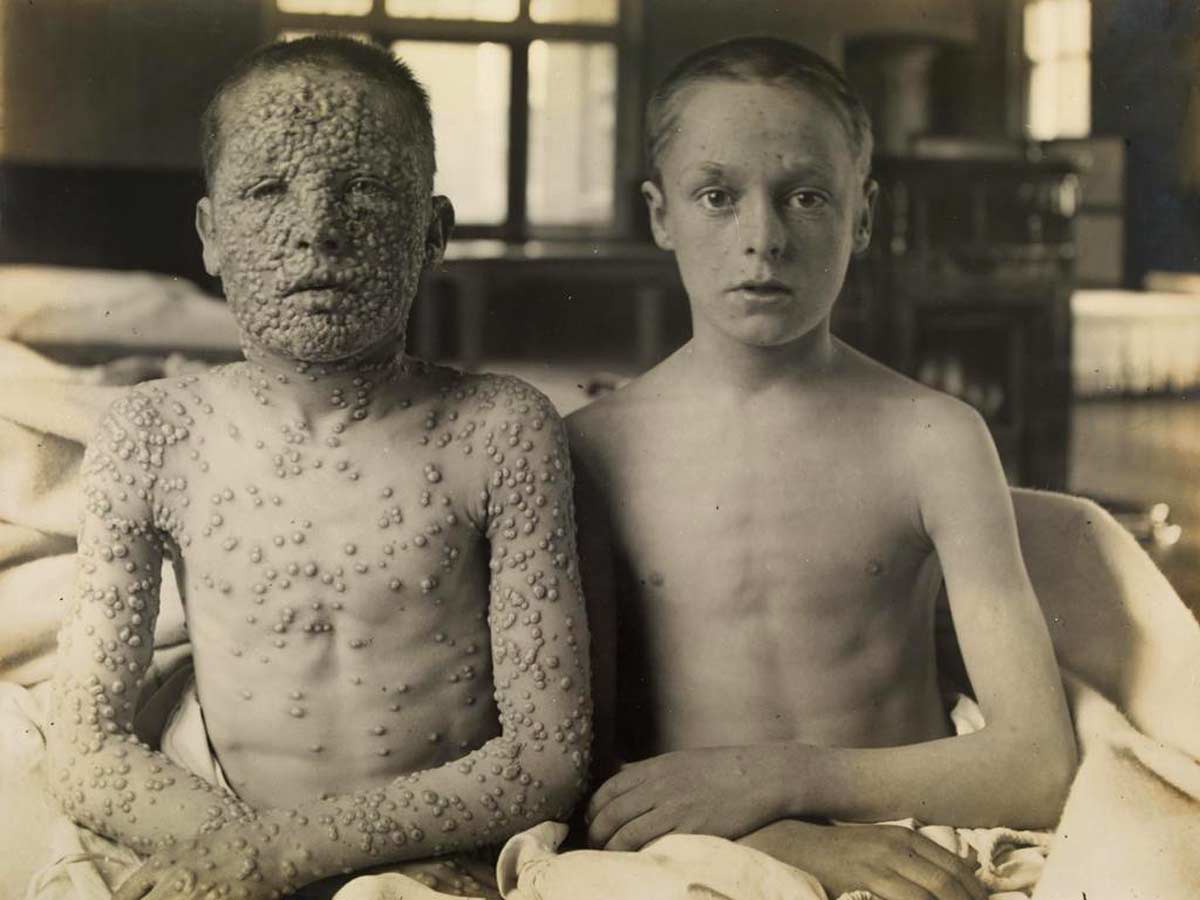 smallpox vaccine boys