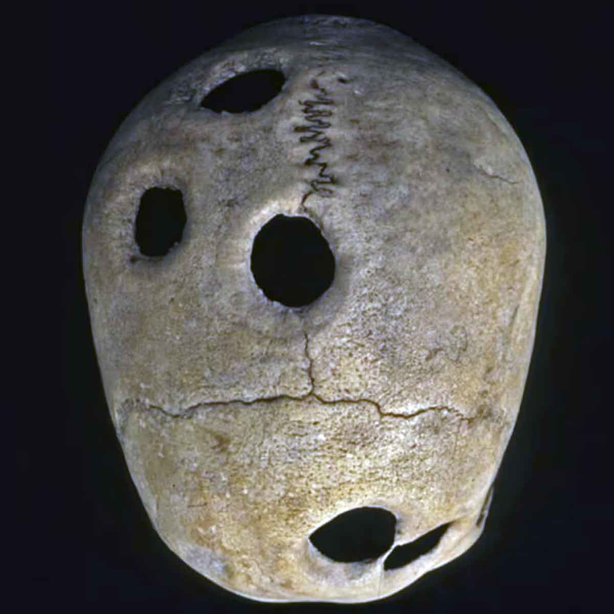 A skull from the Inca Empire showing five healed trepanation holes. Source: World Neurosurgery, Volume 114, June 2018