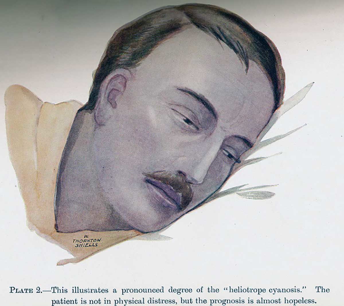 spanish influenza symptoms heliotrope cyanosis drawing