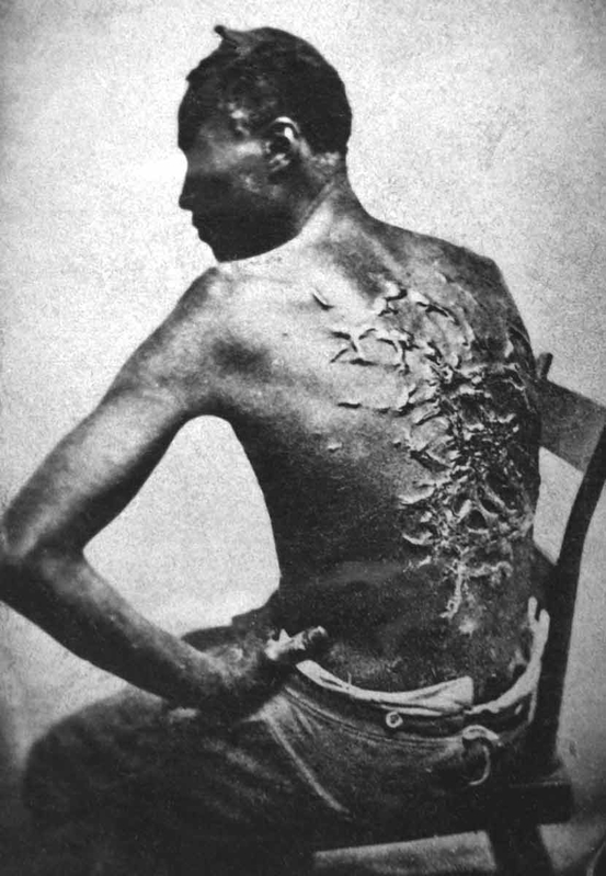 Scars of a whipped Mississippi slave, Baton Rouge, Louisianna, 1863, Source: Wikimedia Commons