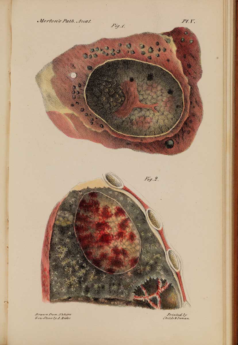 pulmonary tuberculosis anatomical drawing