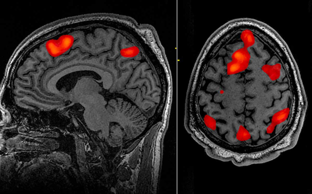 FMRI scan during hypnosis
