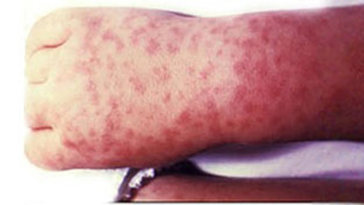 rocky mountain spotted fever