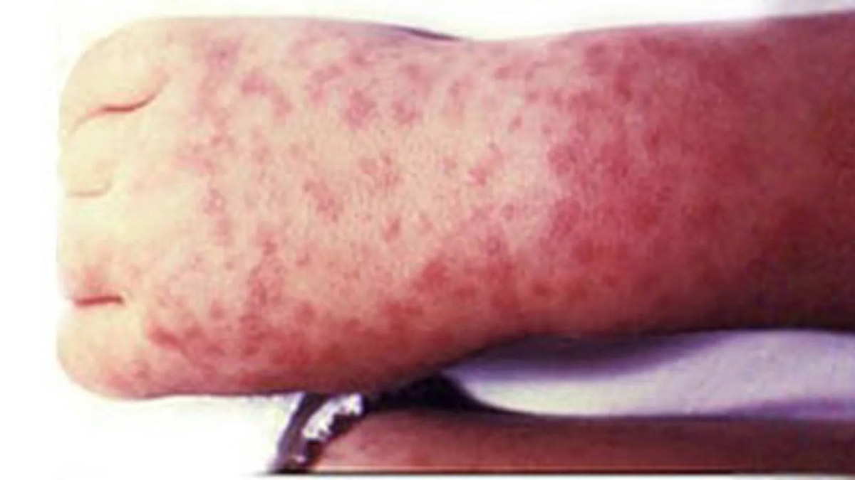 rocky mountain spotted fever