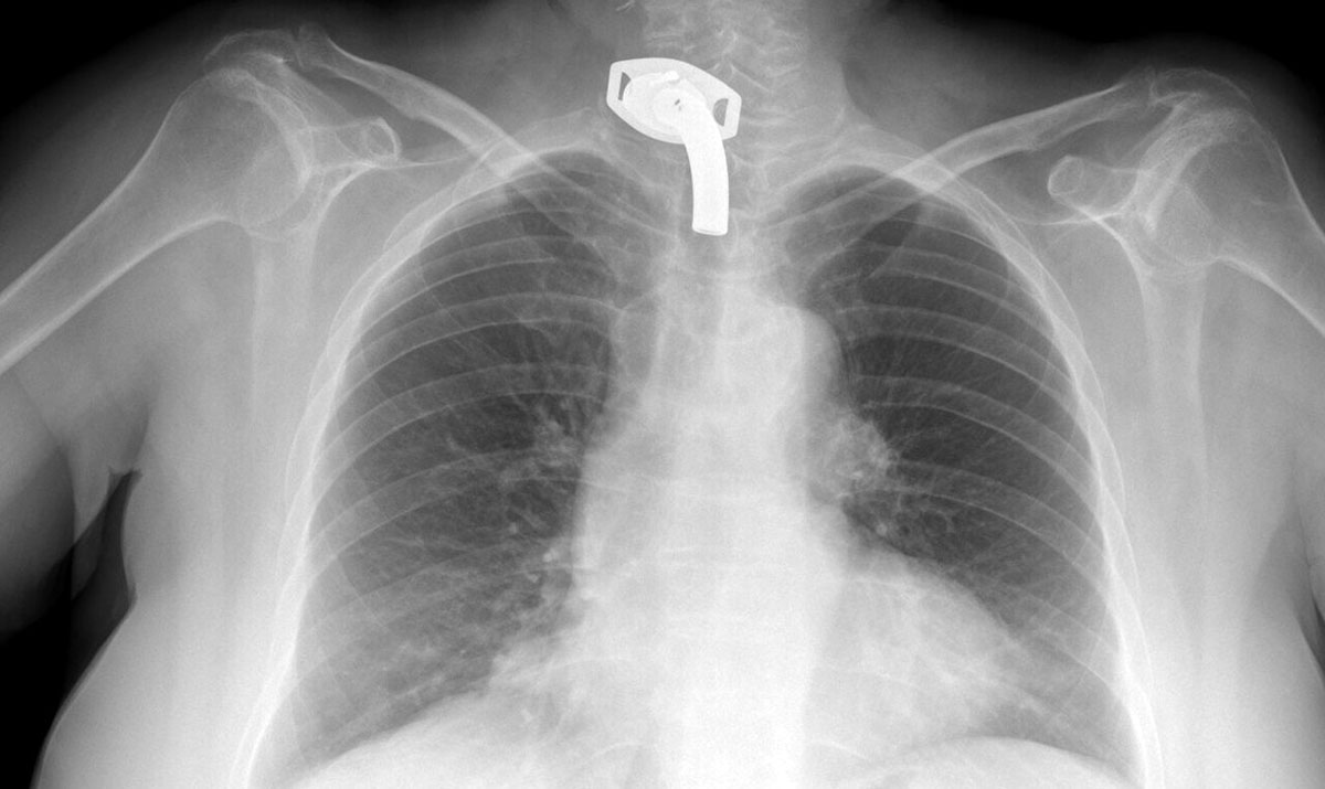 tracheostomy x rays 23
