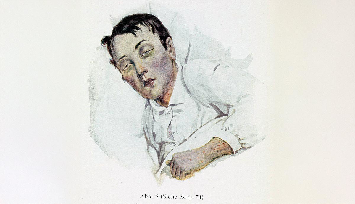 man suffering from typhoid