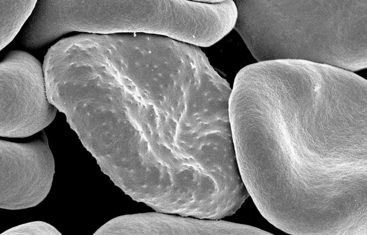 red blood cell with malaria