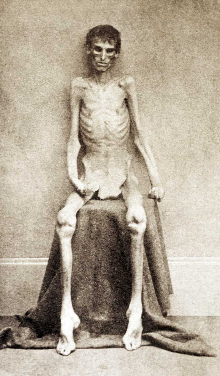 belle isle emaciated pow