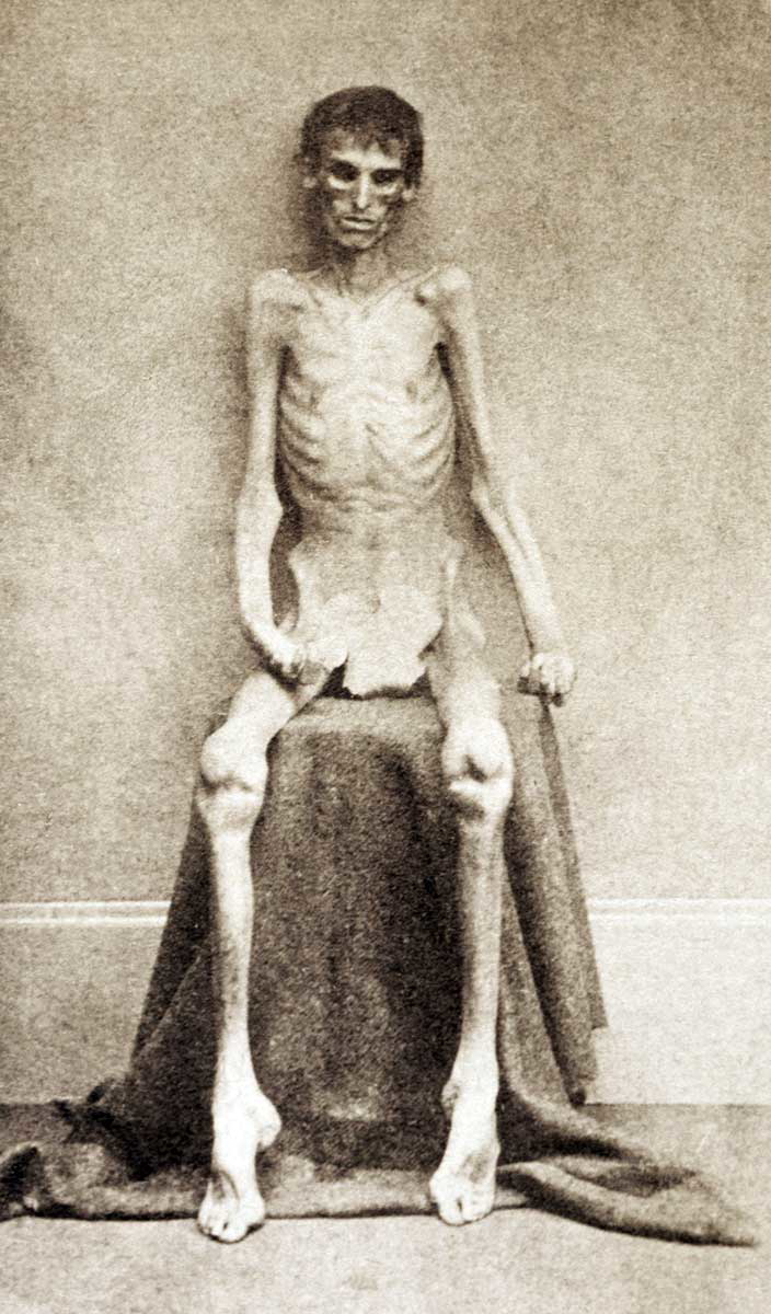 belle isle emaciated pow