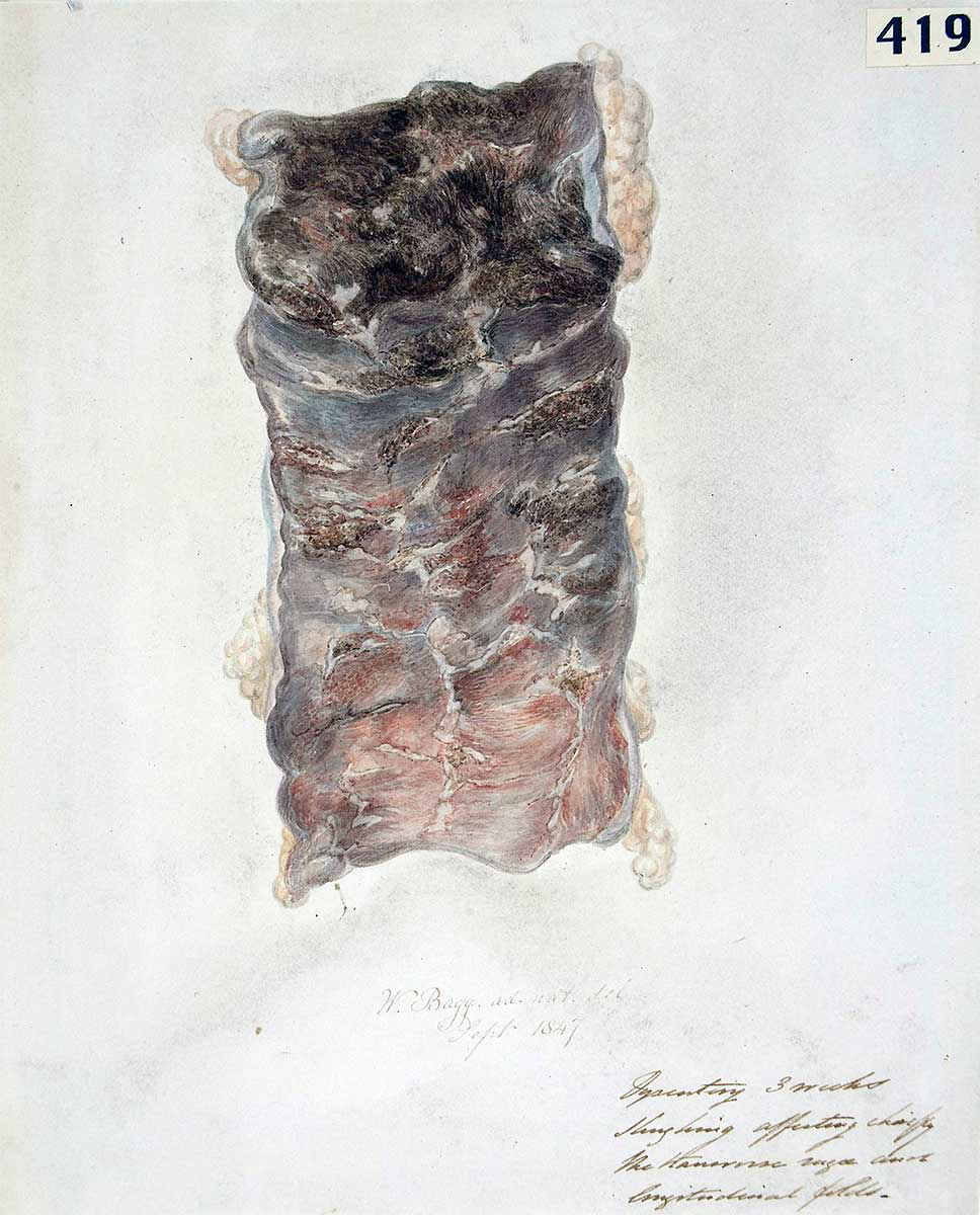 intestinal lining after dysentery