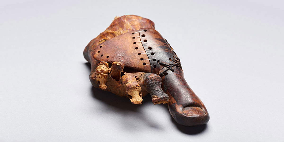 cairo toe prosthesis