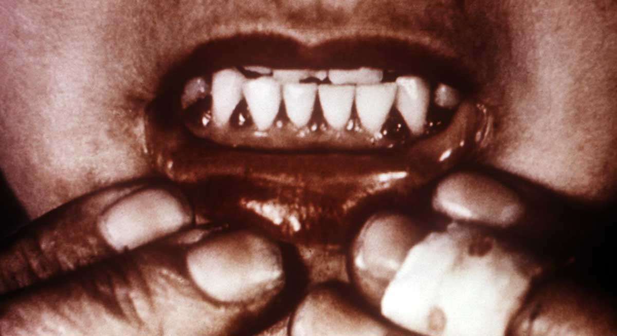 gums infected with scurvy