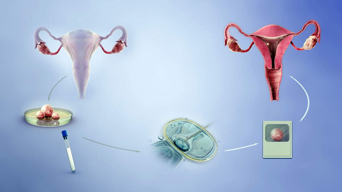ivf diagram jean purdy