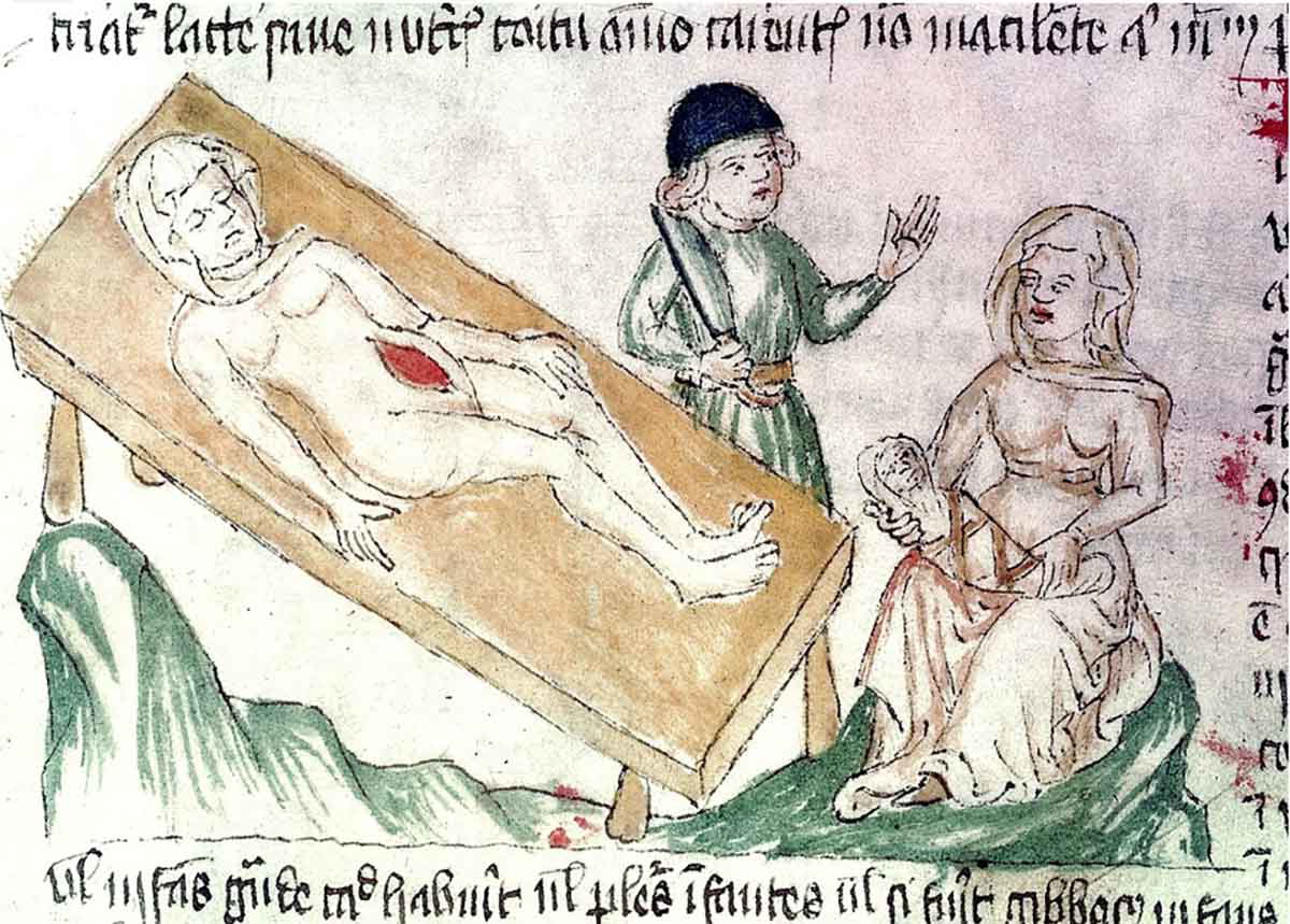 medieval caesarian