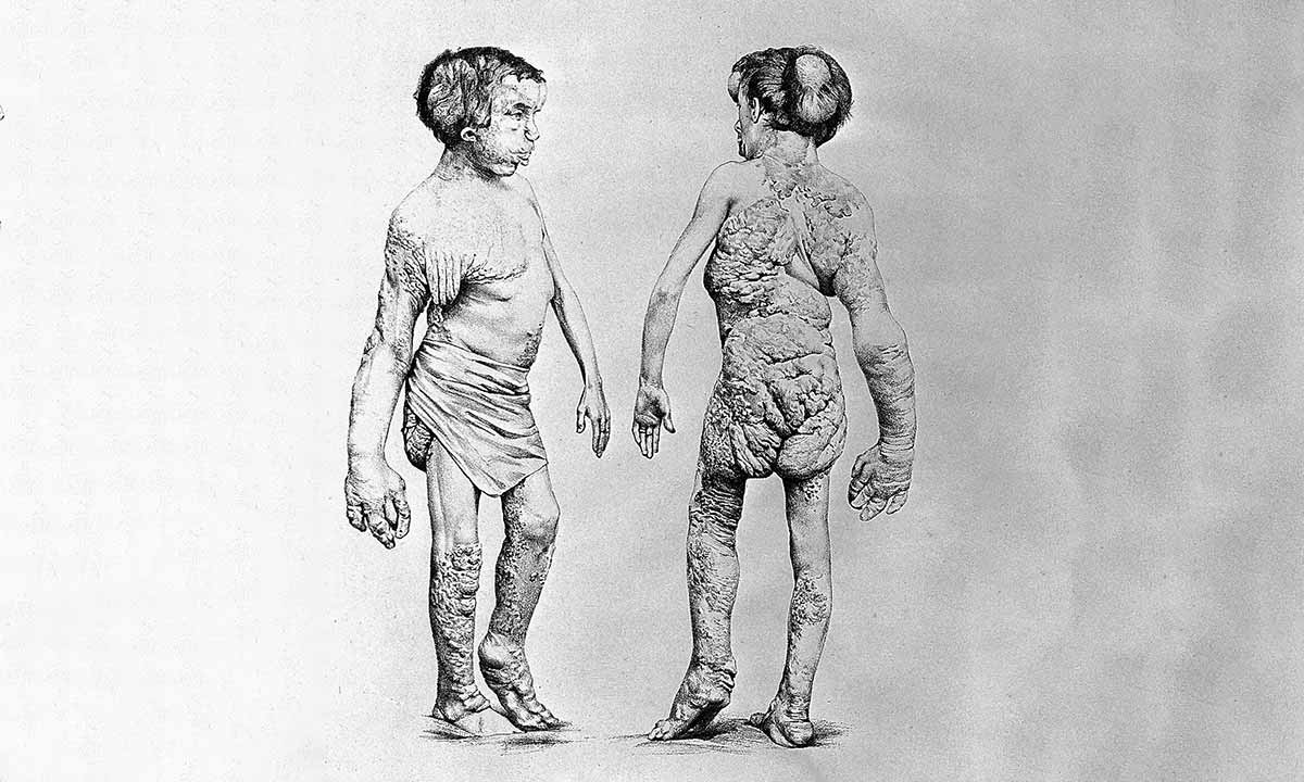 joseph merrick illustration