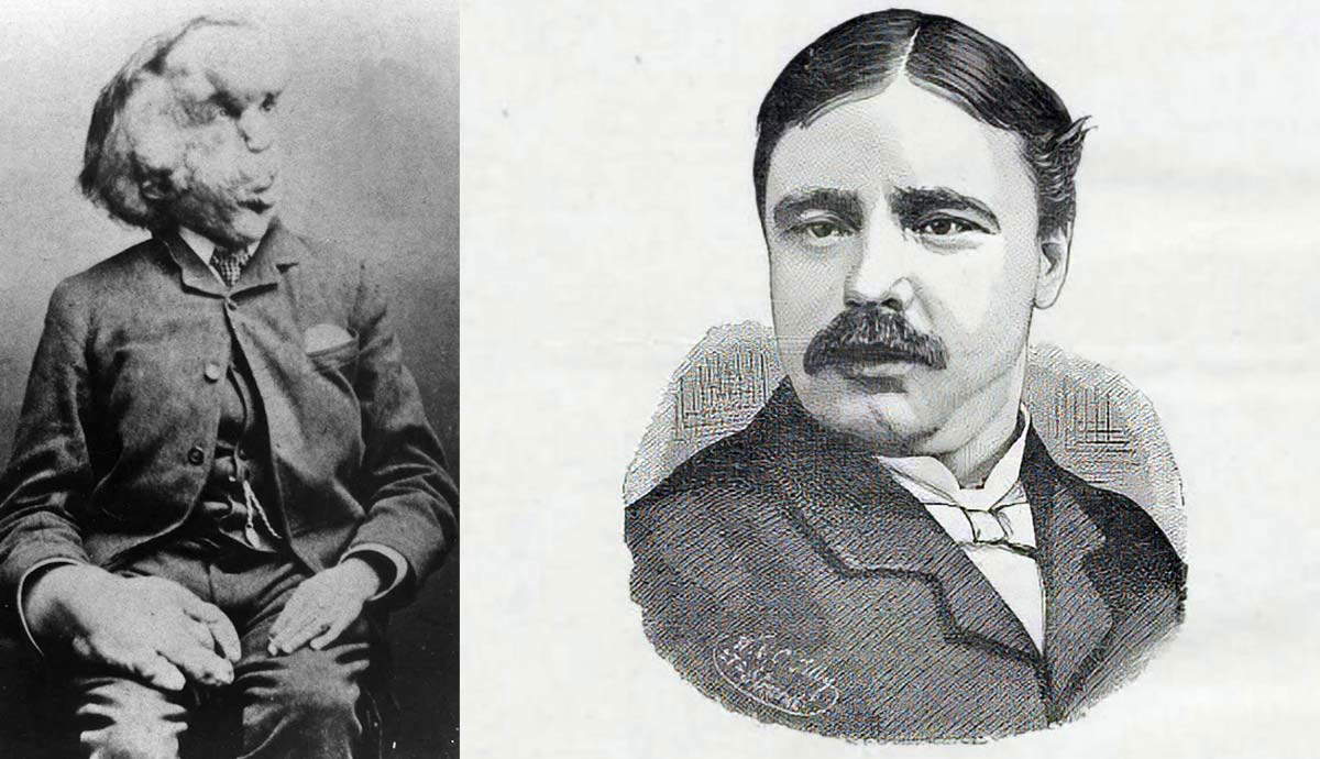 joseph merrick portrait