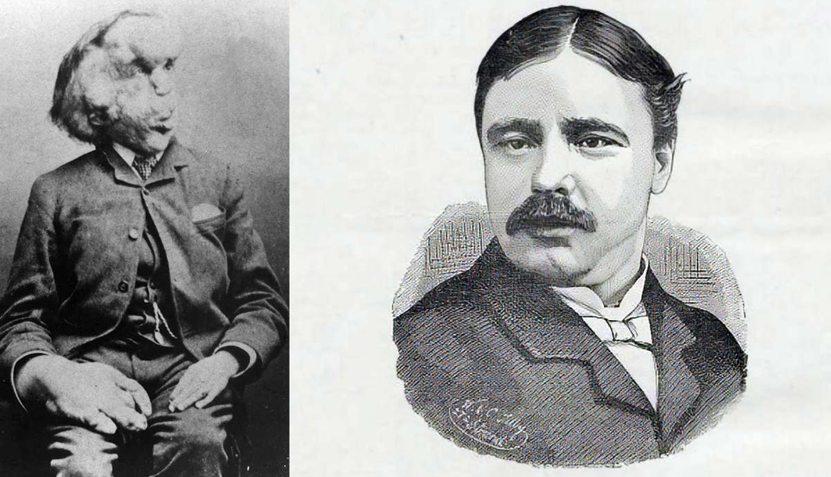 joseph merrick portrait