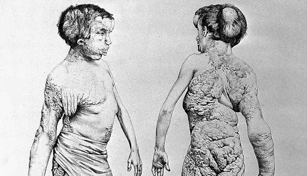 Illustration of Joseph Merrick