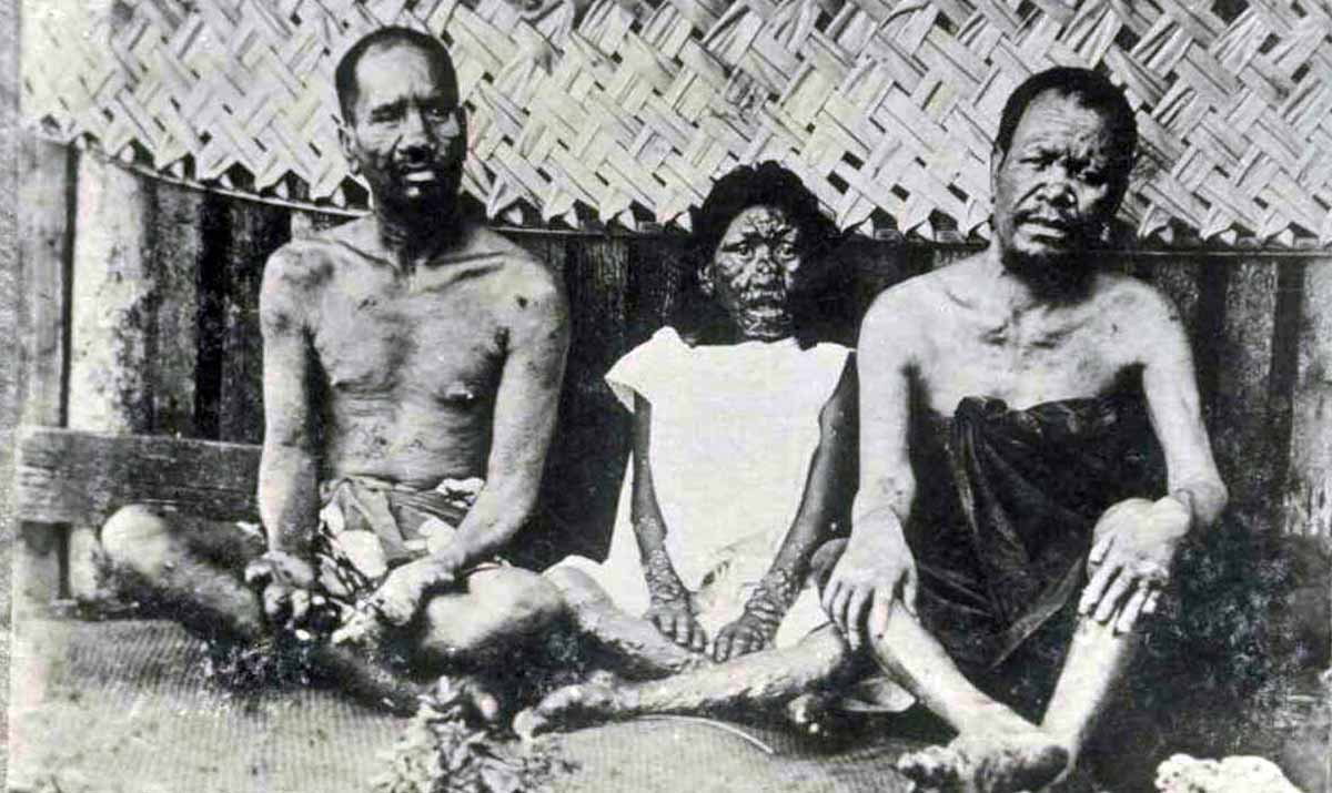lepers in the 19th century