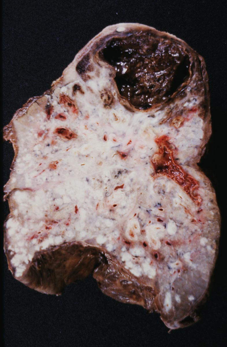 tb patient lung cavity