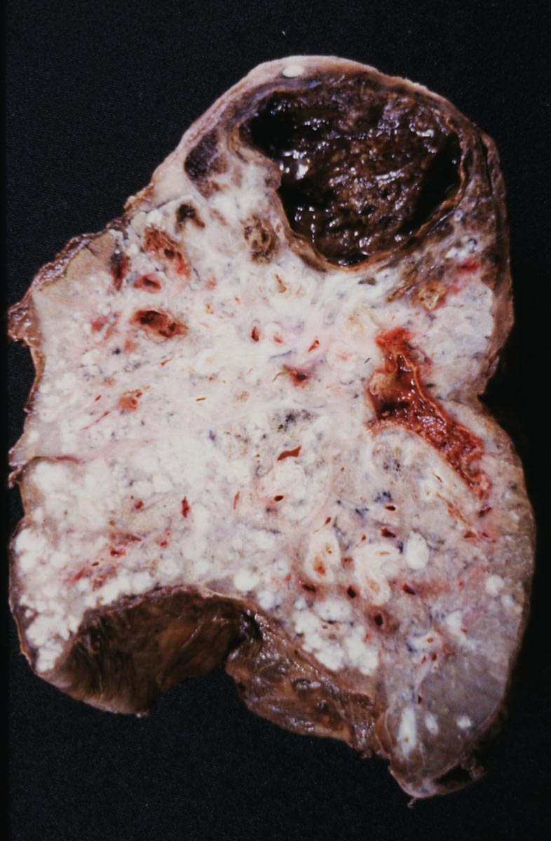 tb patient lung cavity