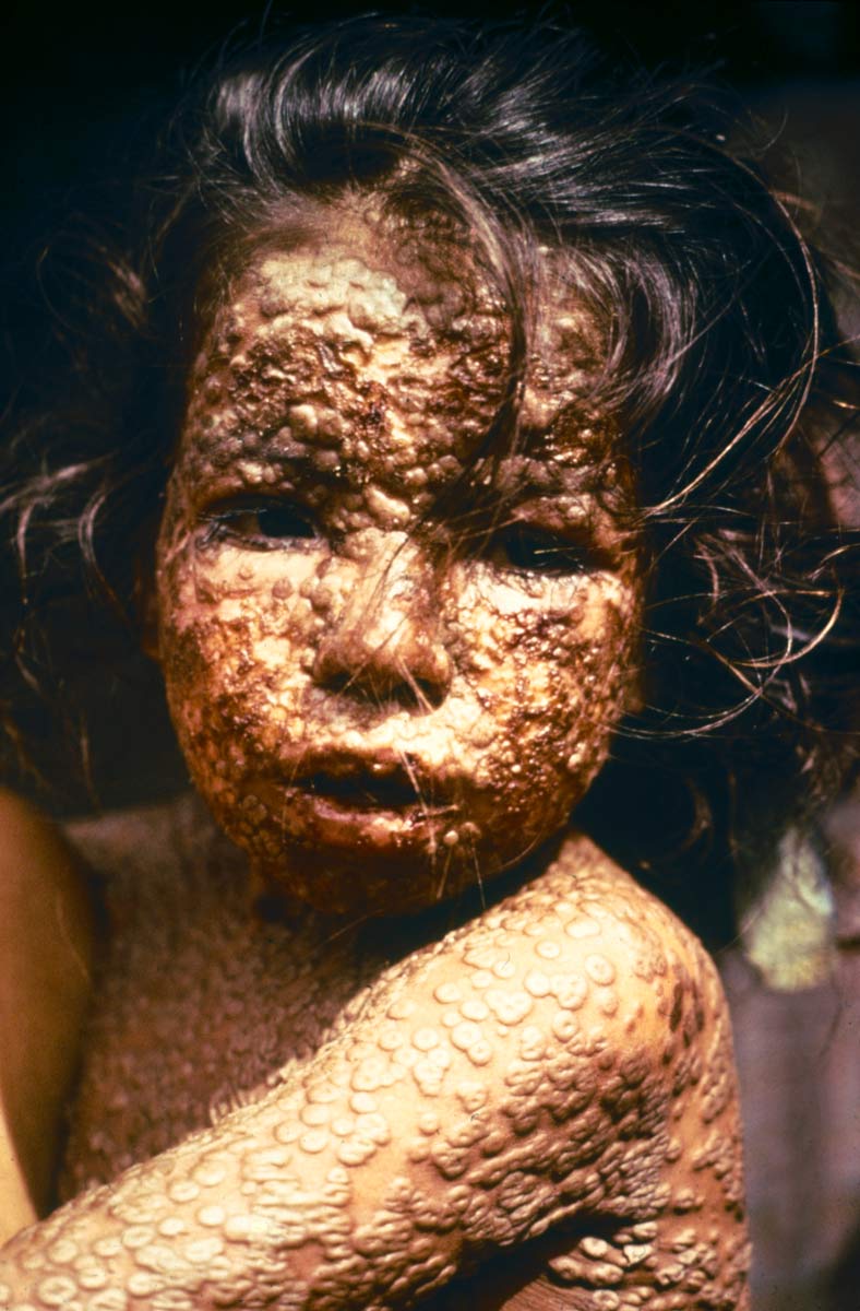 child smallpox bangladesh